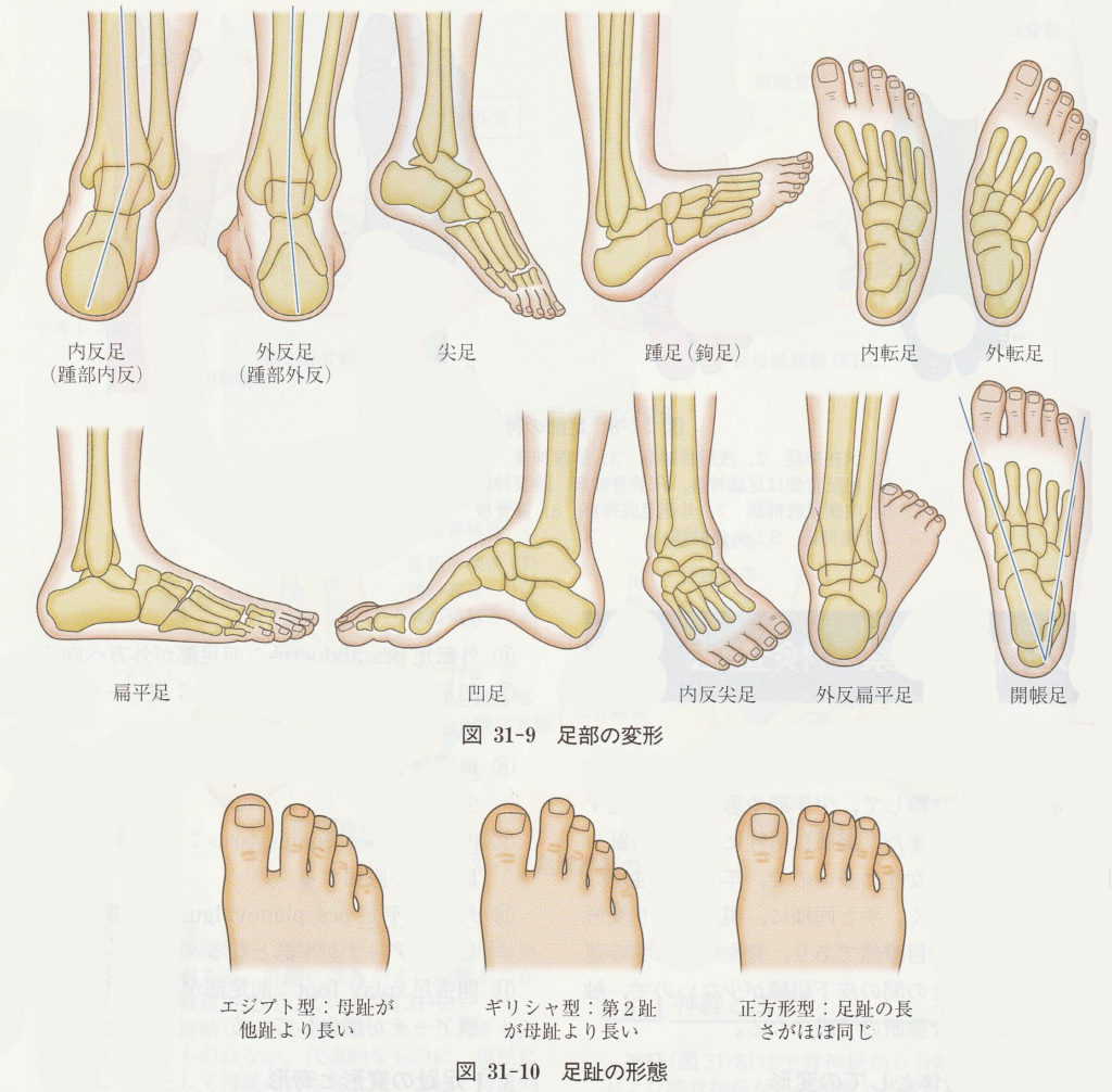 足部の変形や歪み
